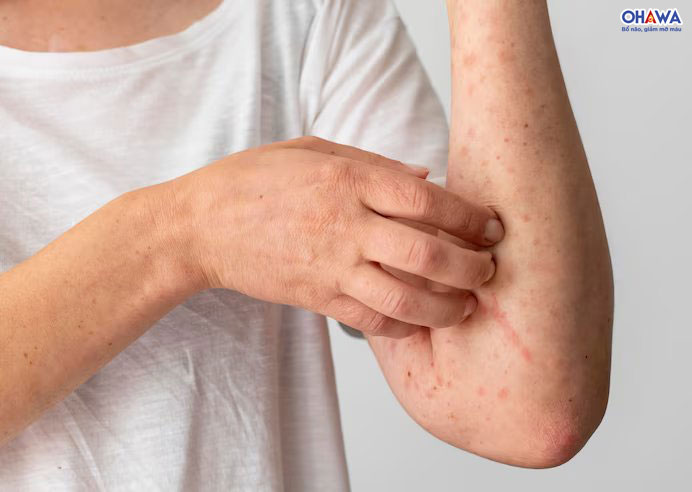 Điều trị viêm da dị ứng