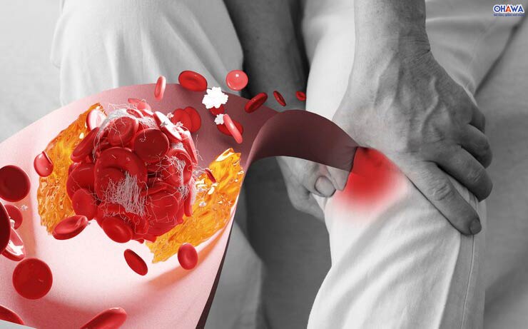 Triệu chứng bệnh xơ vữa động mạch